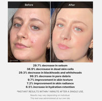 Medicube Red Acne Succinic Acid Peel 40g